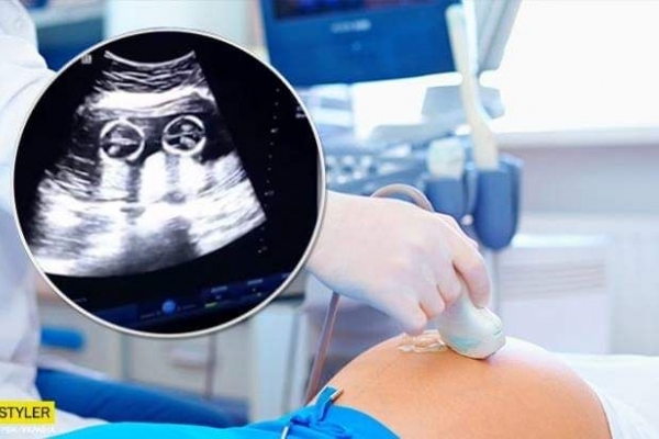  Бійка близнюків в утробі матері: в мережі показали захоплююче відео 